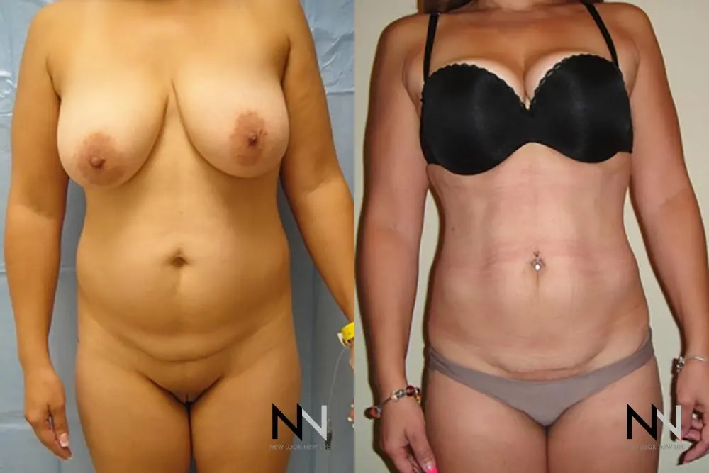 Liposuction: Patient 3 - Before and After  