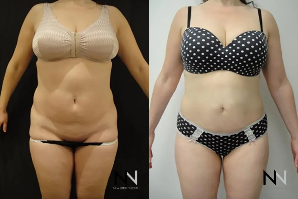 Liposuction: Patient 1 - Before and After  