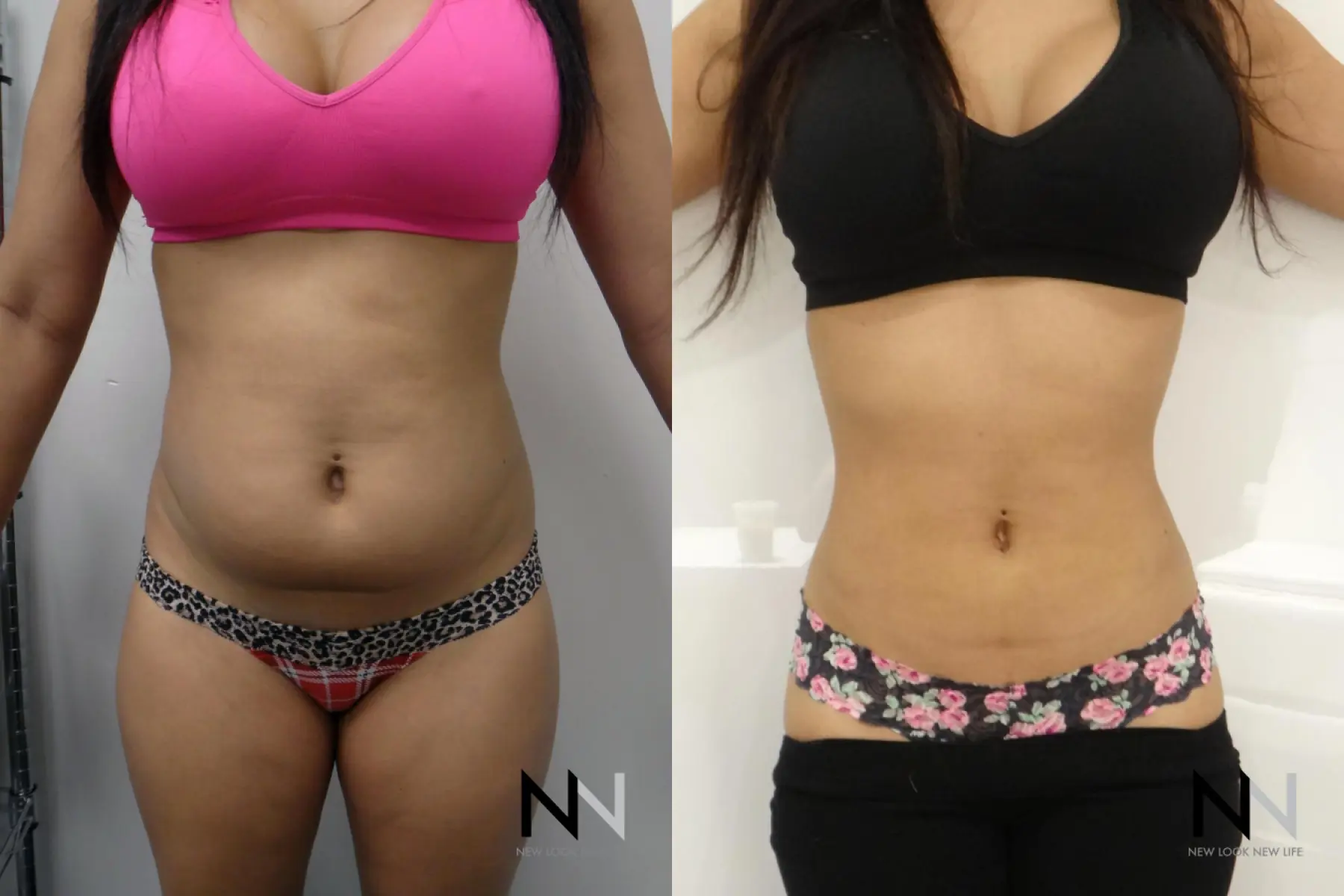 Liposuction: Patient 5 - Before and After  