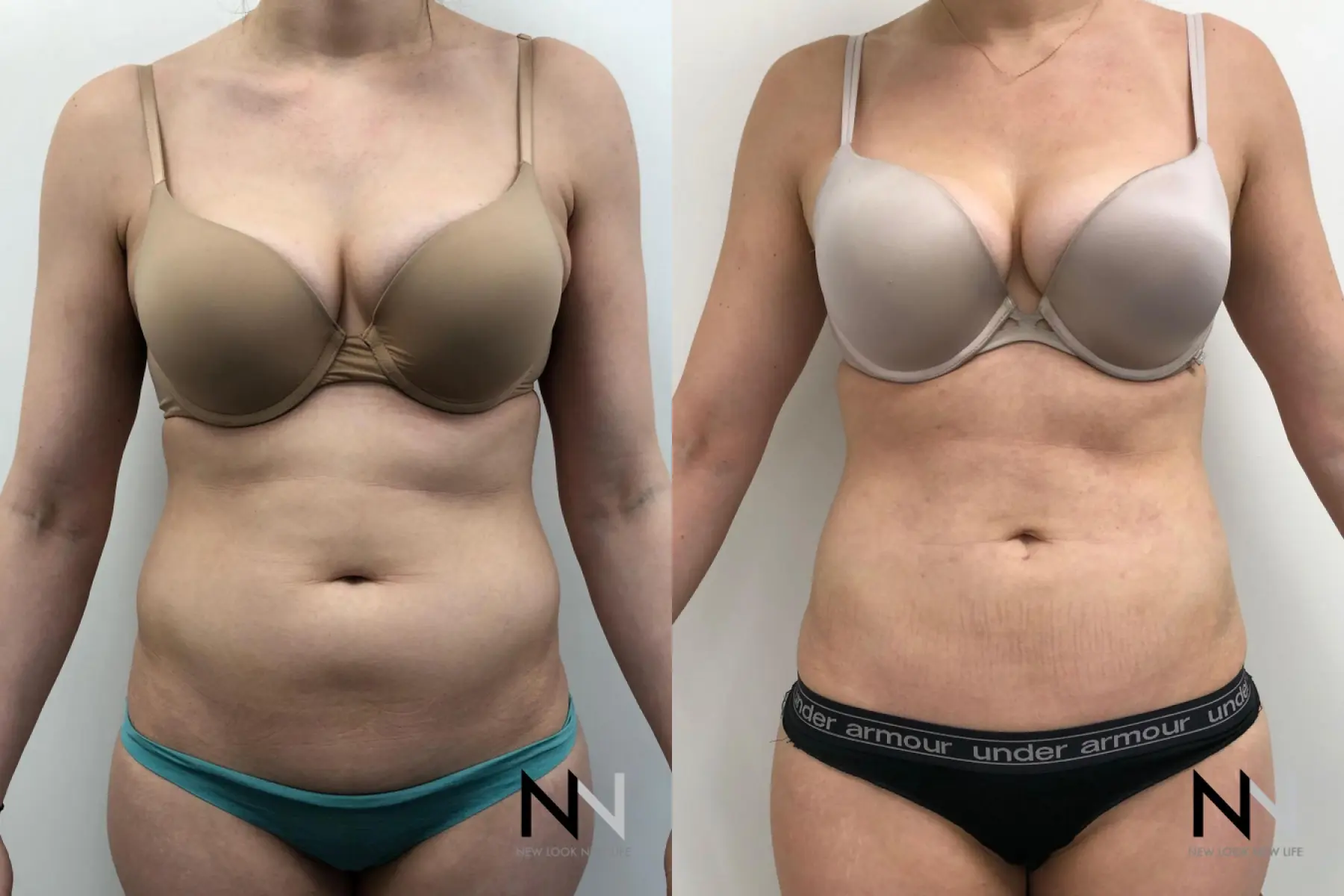 Liposuction: Patient 9 - Before and After  