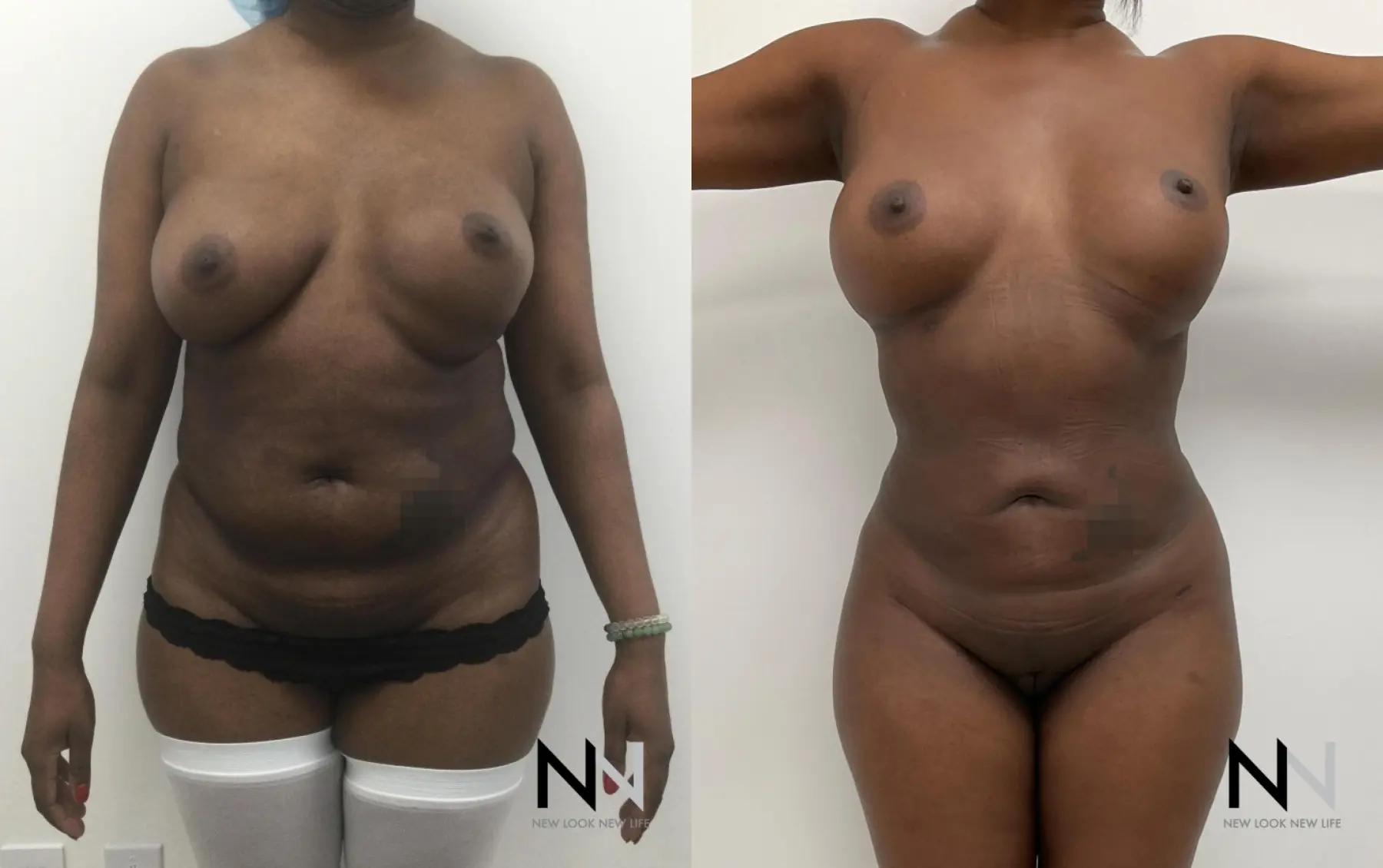 Liposuction: Patient 10 - Before and After  