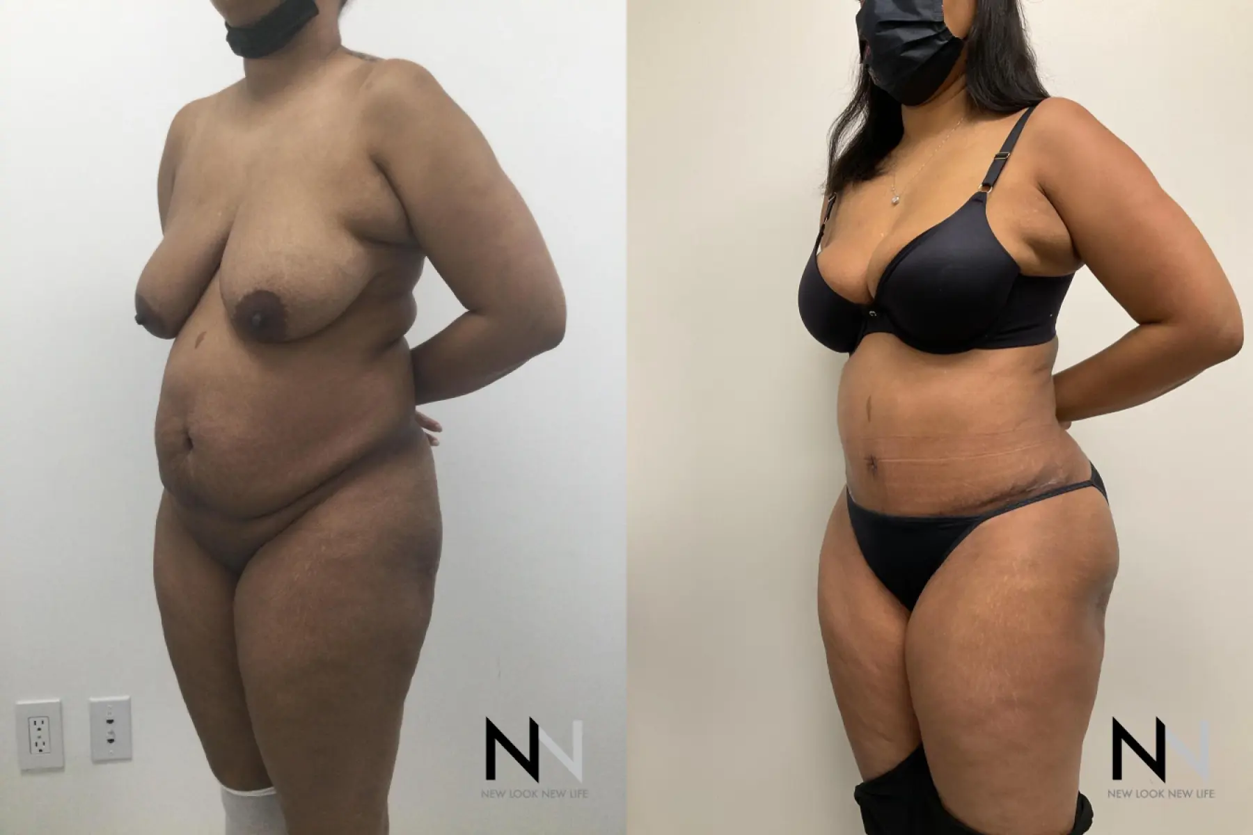 Liposuction: Patient 8 - Before and After  