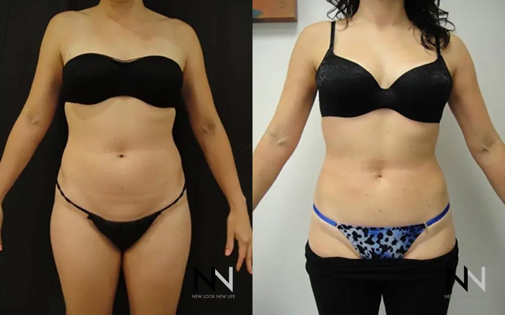 Liposuction: Patient 7 - Before and After  