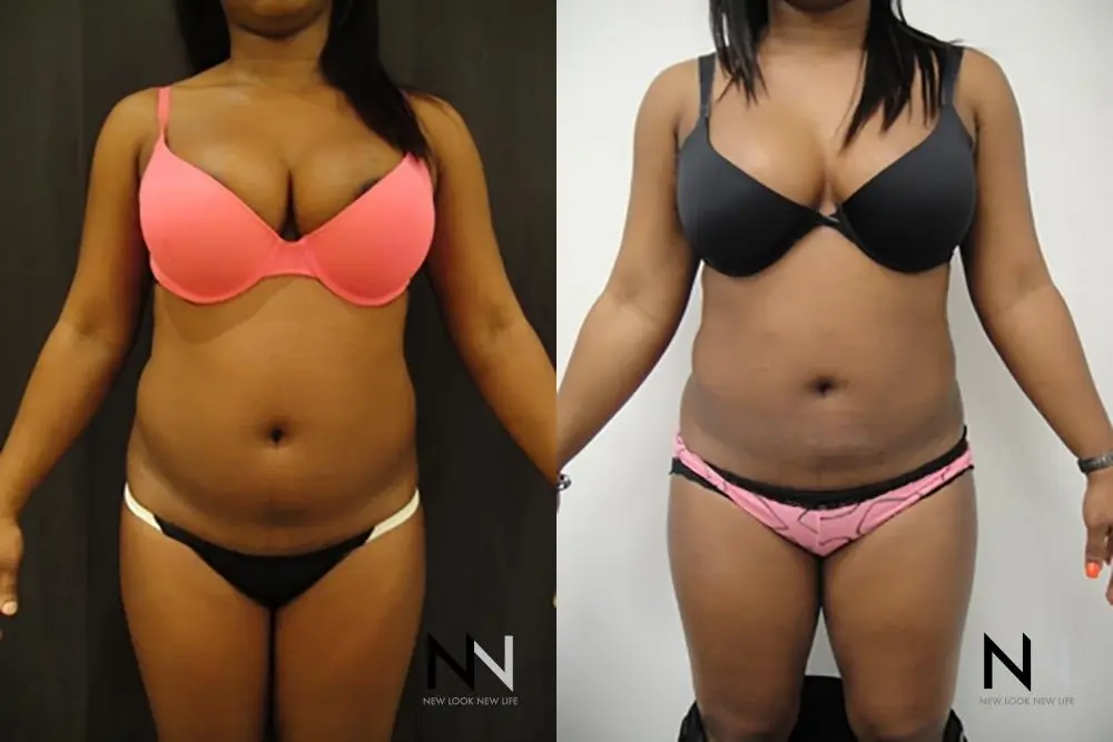 Liposuction: Patient 2 - Before and After  