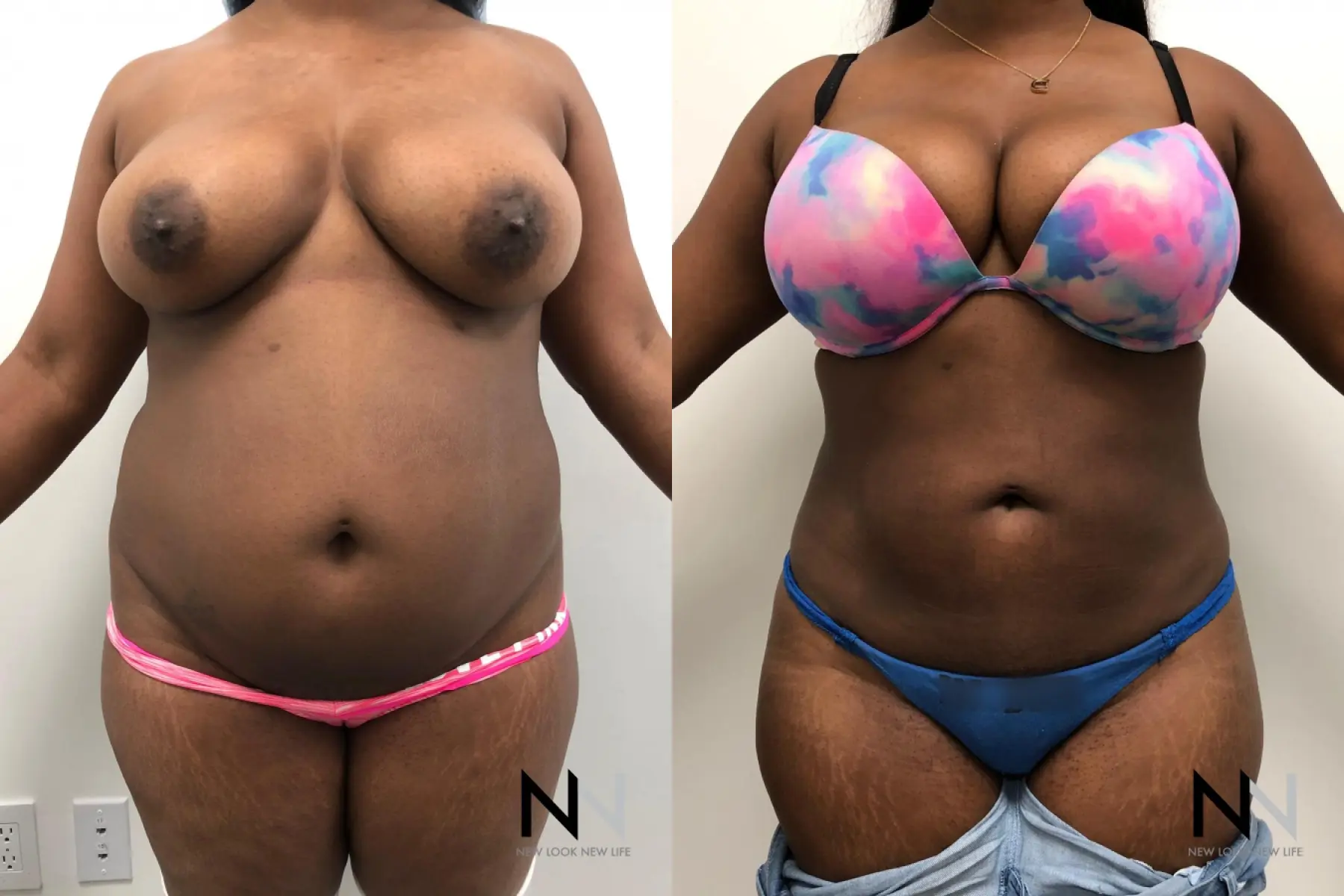 Liposuction: Patient 6 - Before and After  