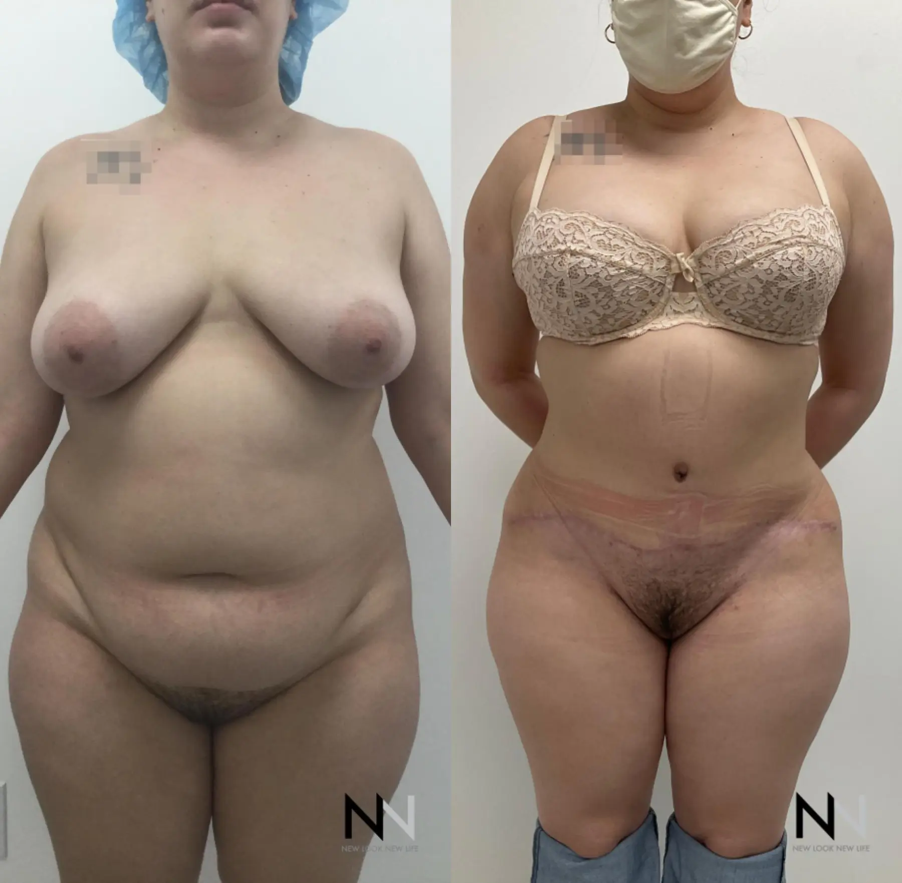 Liposuction: Patient 4 - Before and After  