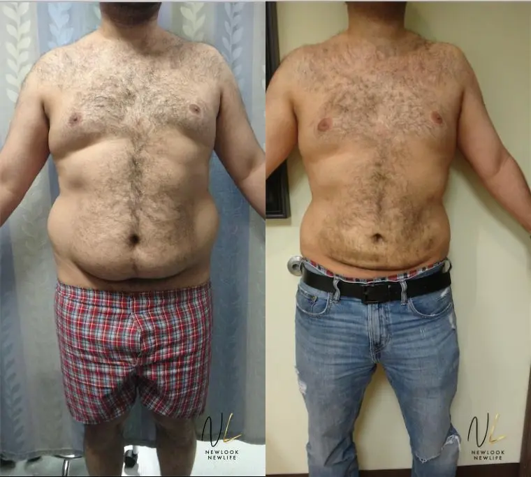 Male Liposuction: Patient 5 - Before and After  