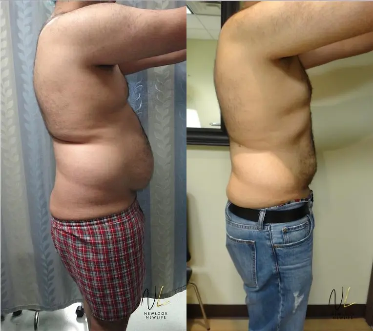 Male Liposuction: Patient 5 - Before and After 3