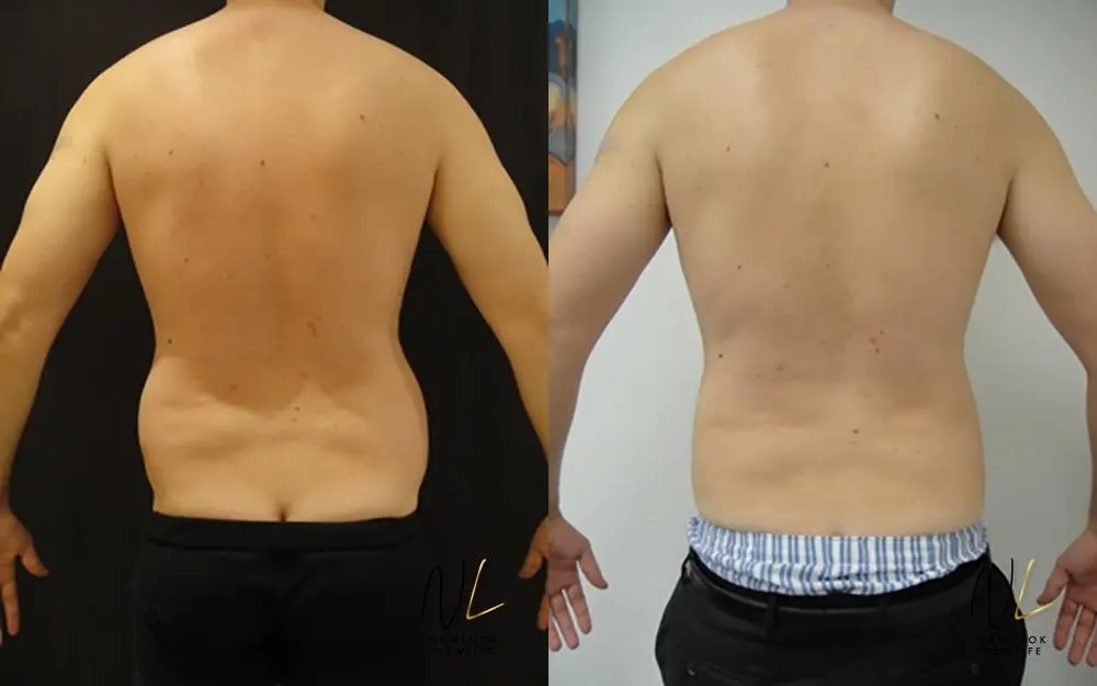 Male Liposuction: Patient 7 - Before and After  