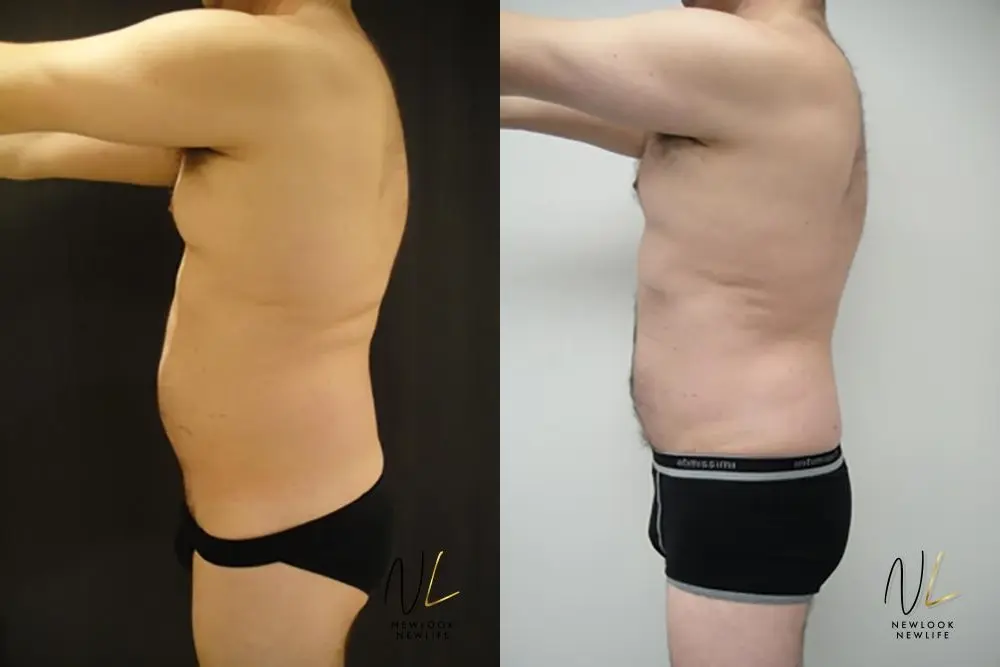 Male Liposuction: Patient 6 - Before and After 1