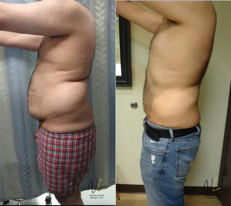 Male Liposuction: Patient 5 - Before and After 2