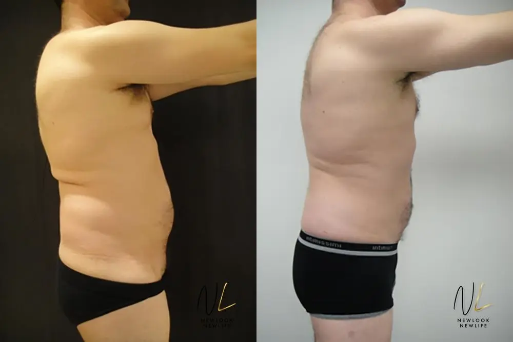 Male Liposuction: Patient 6 - Before and After 2