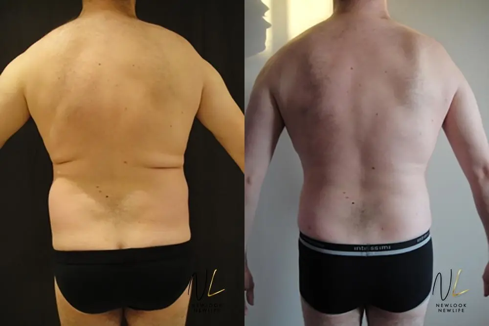 Male Liposuction: Patient 6 - Before and After 3