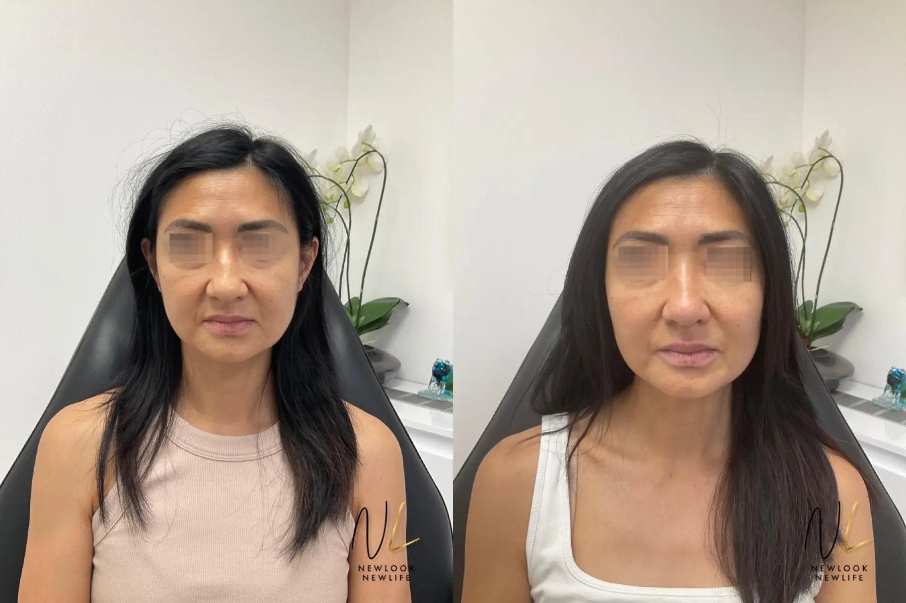 Liquid Facelift: Patient 1 - Before and After  