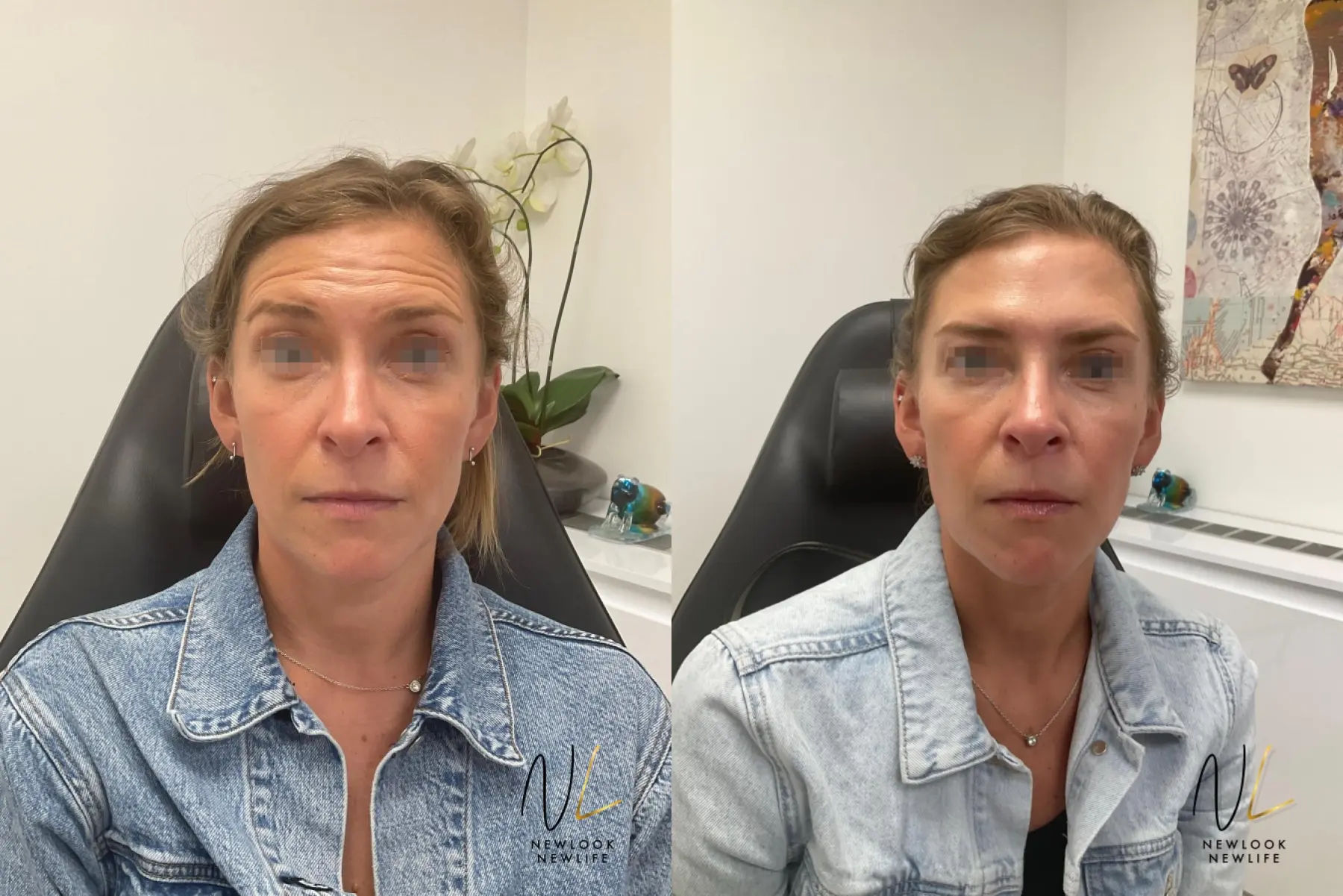 Liquid Facelift: Patient 10 - Before and After  