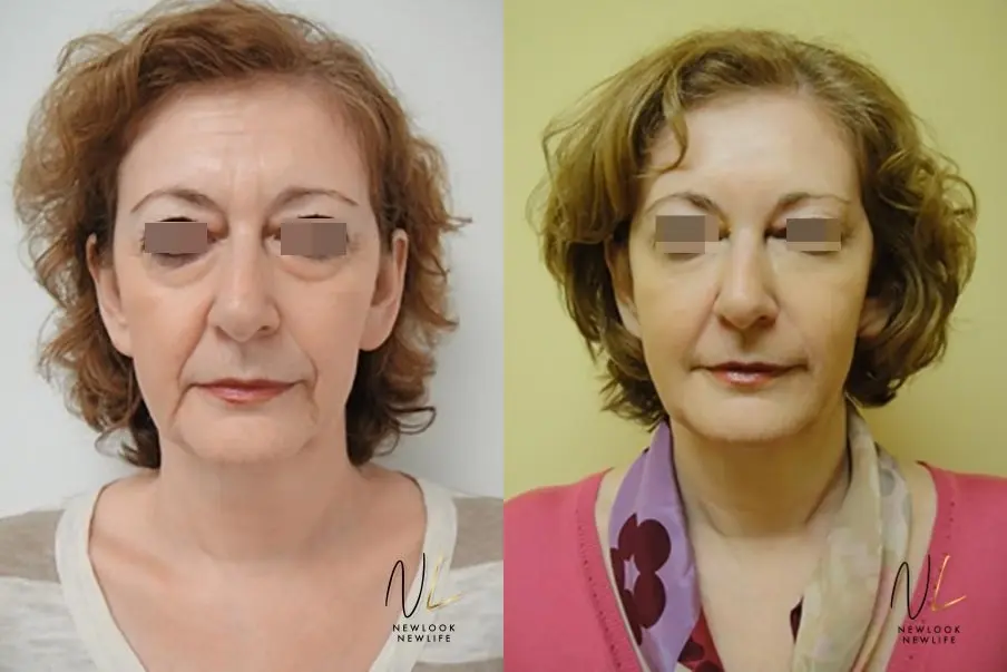 Liquid Facelift: Patient 4 - Before and After  