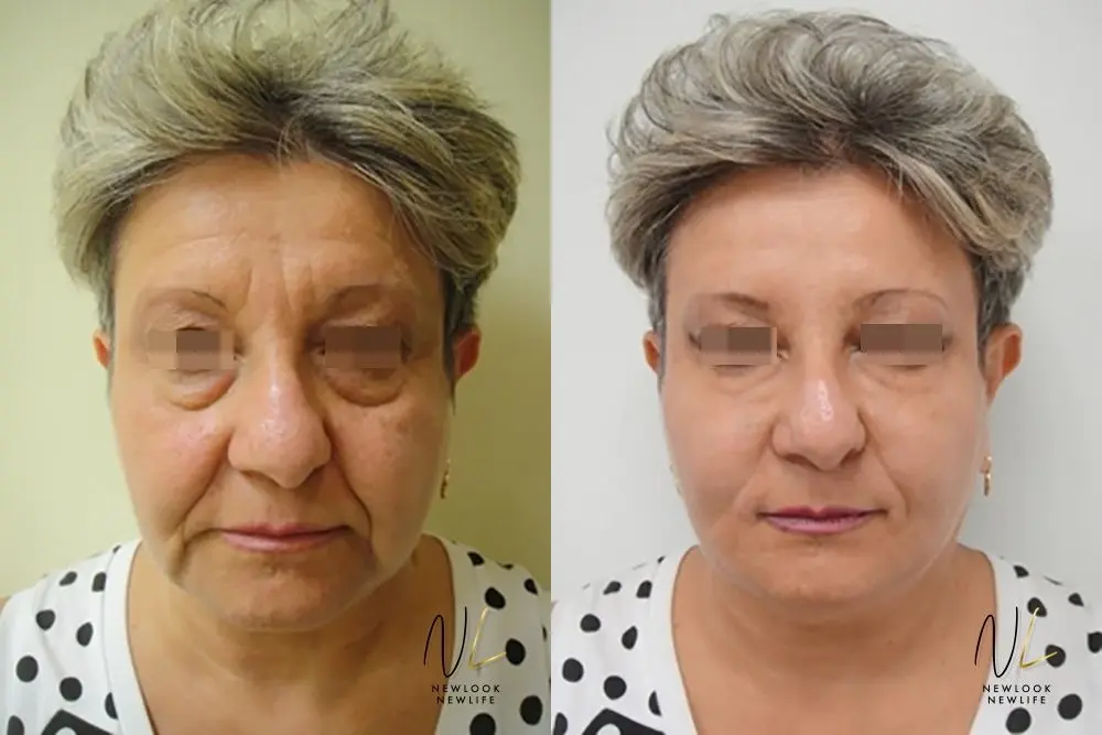 Liquid Facelift: Patient 5 - Before and After  