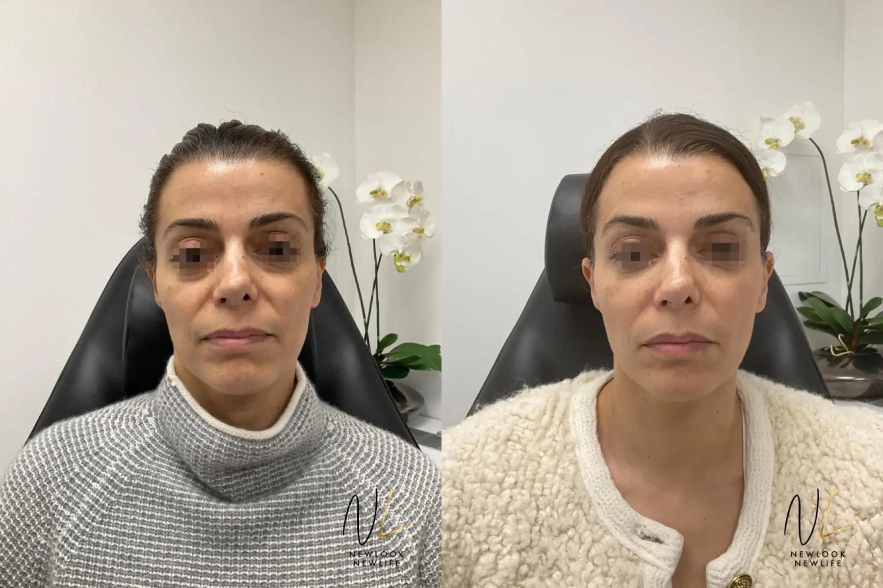 Liquid Facelift: Patient 9 - Before and After  