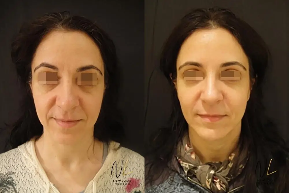 Liquid Facelift: Patient 2 - Before and After  