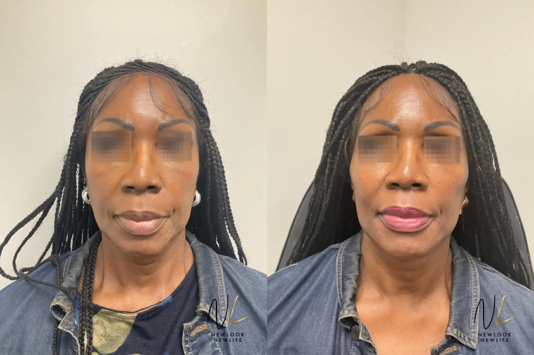 Liquid Facelift: Patient 3 - Before and After  