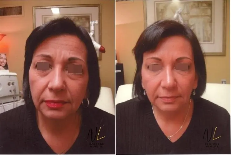 Liquid Facelift: Patient 7 - Before and After  