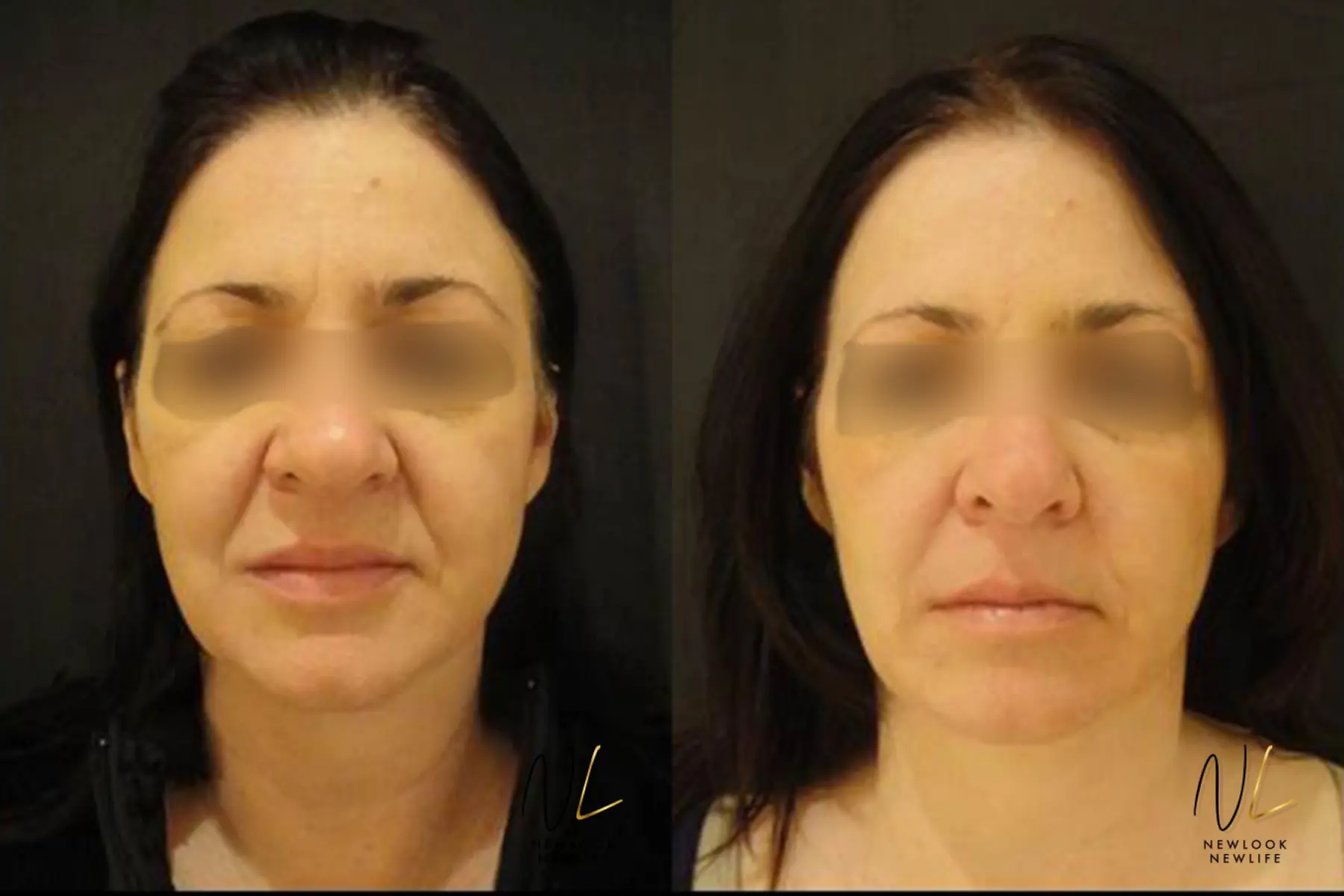 Liquid Facelift: Patient 6 - Before and After  