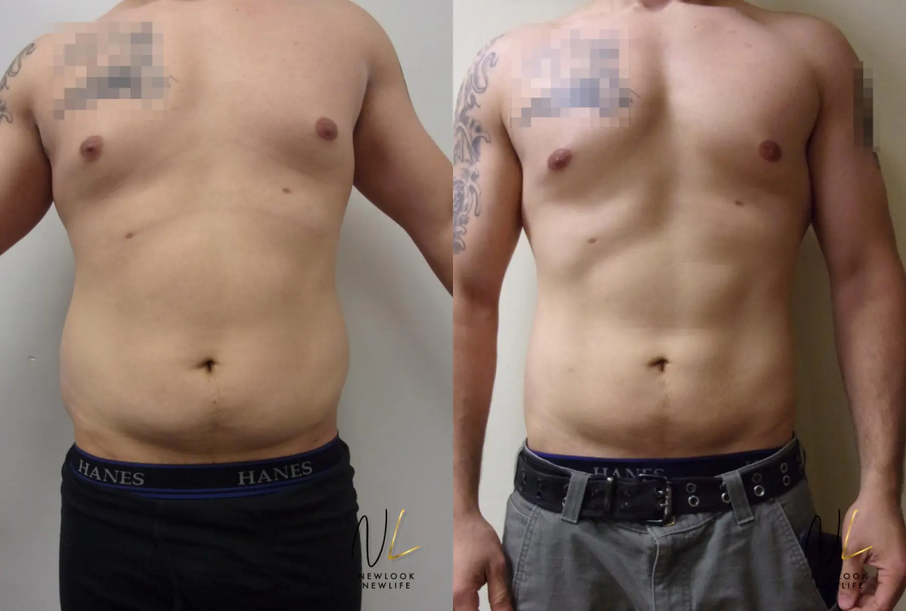 Male Liposuction: Patient 2 - Before and After  