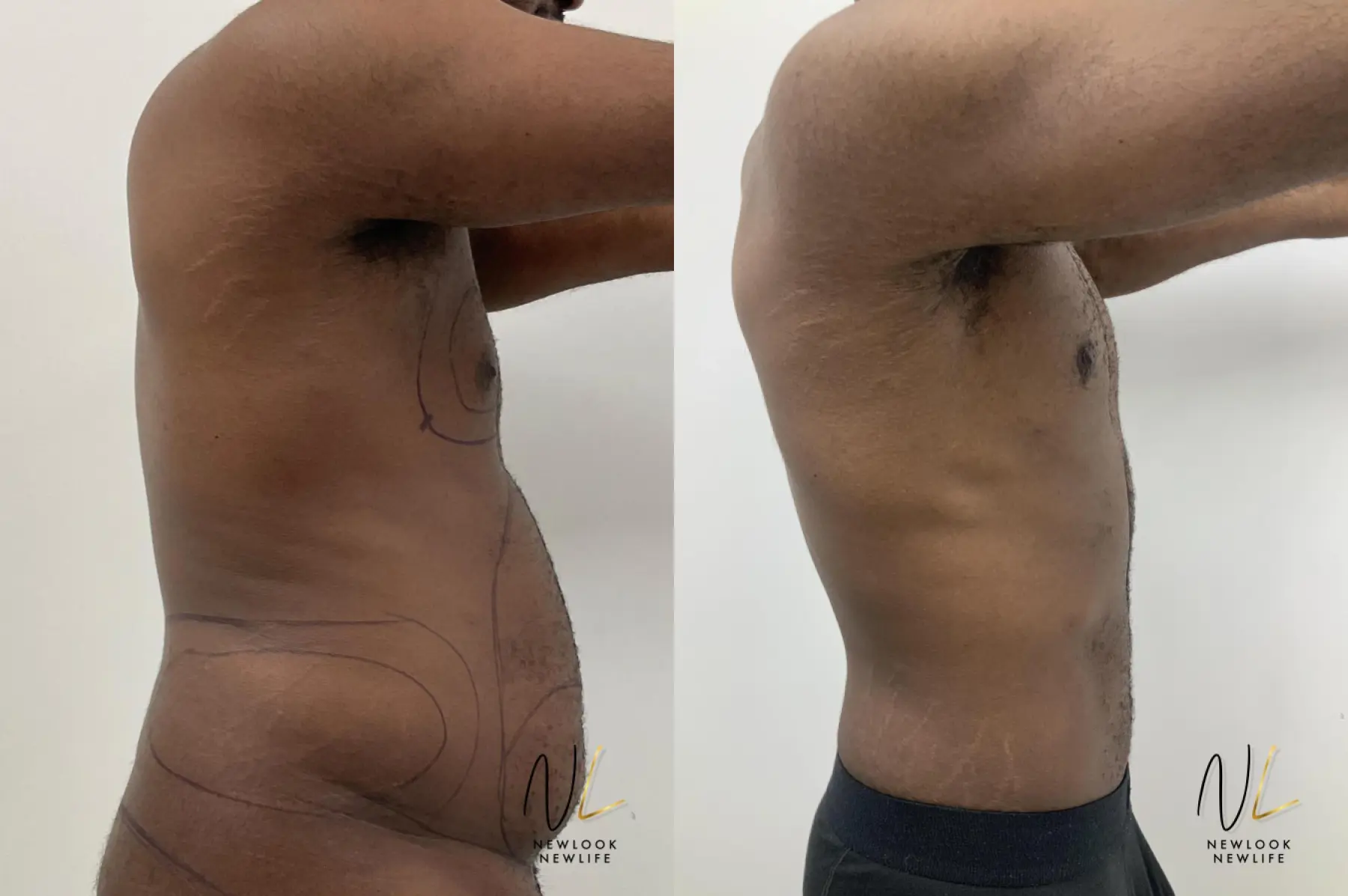 Male Liposuction: Patient 1 - Before and After 6