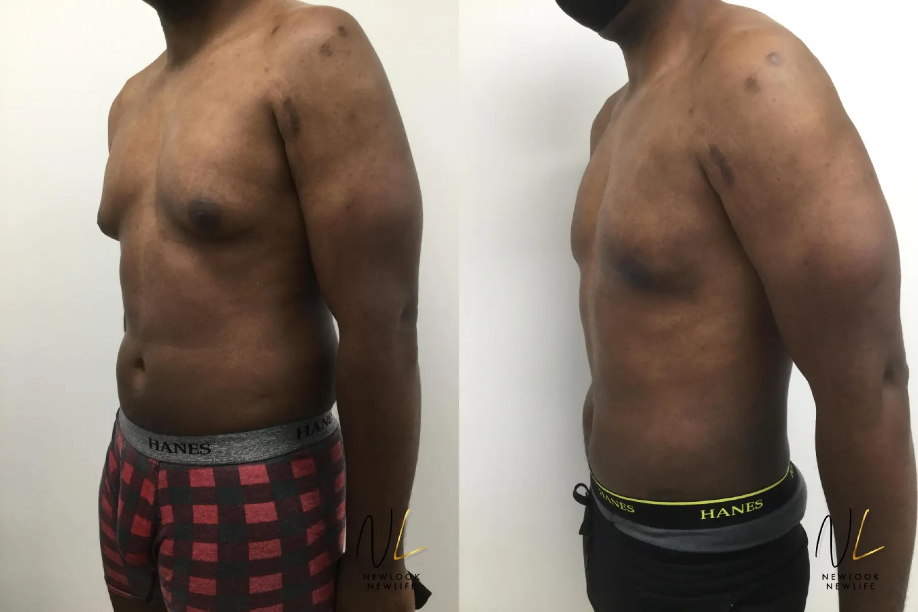 Male Liposuction: Patient 4 - Before and After 4