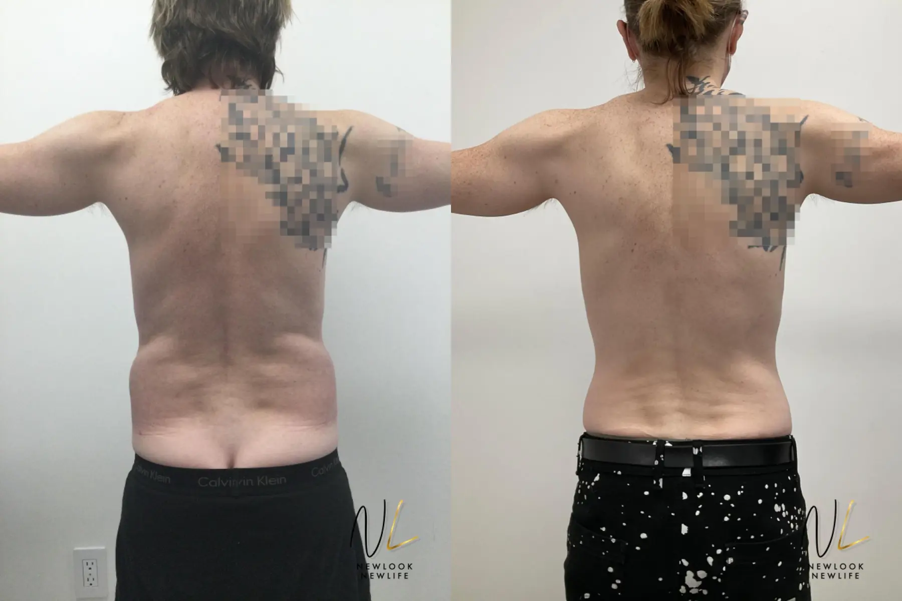 Male Liposuction: Patient 10 - Before and After 6