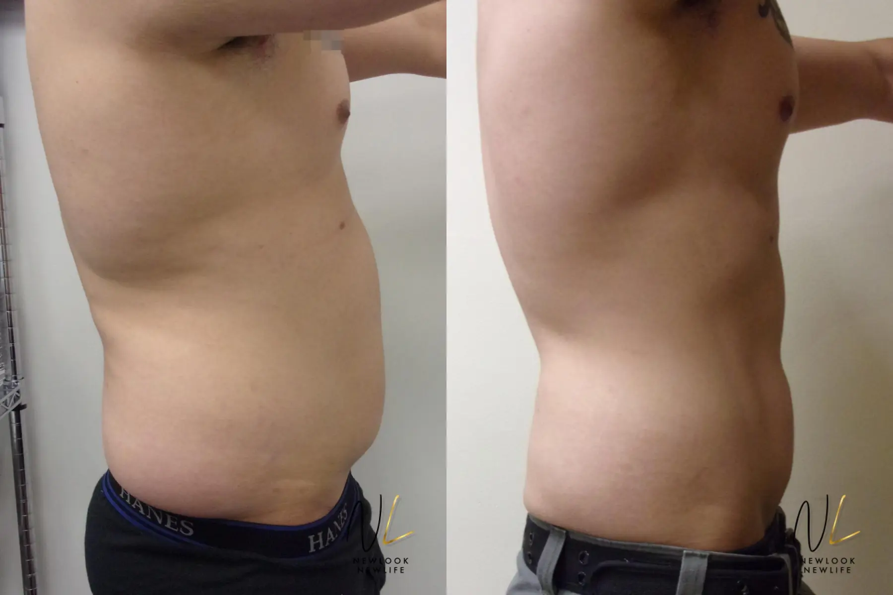 Male Liposuction: Patient 2 - Before and After 3