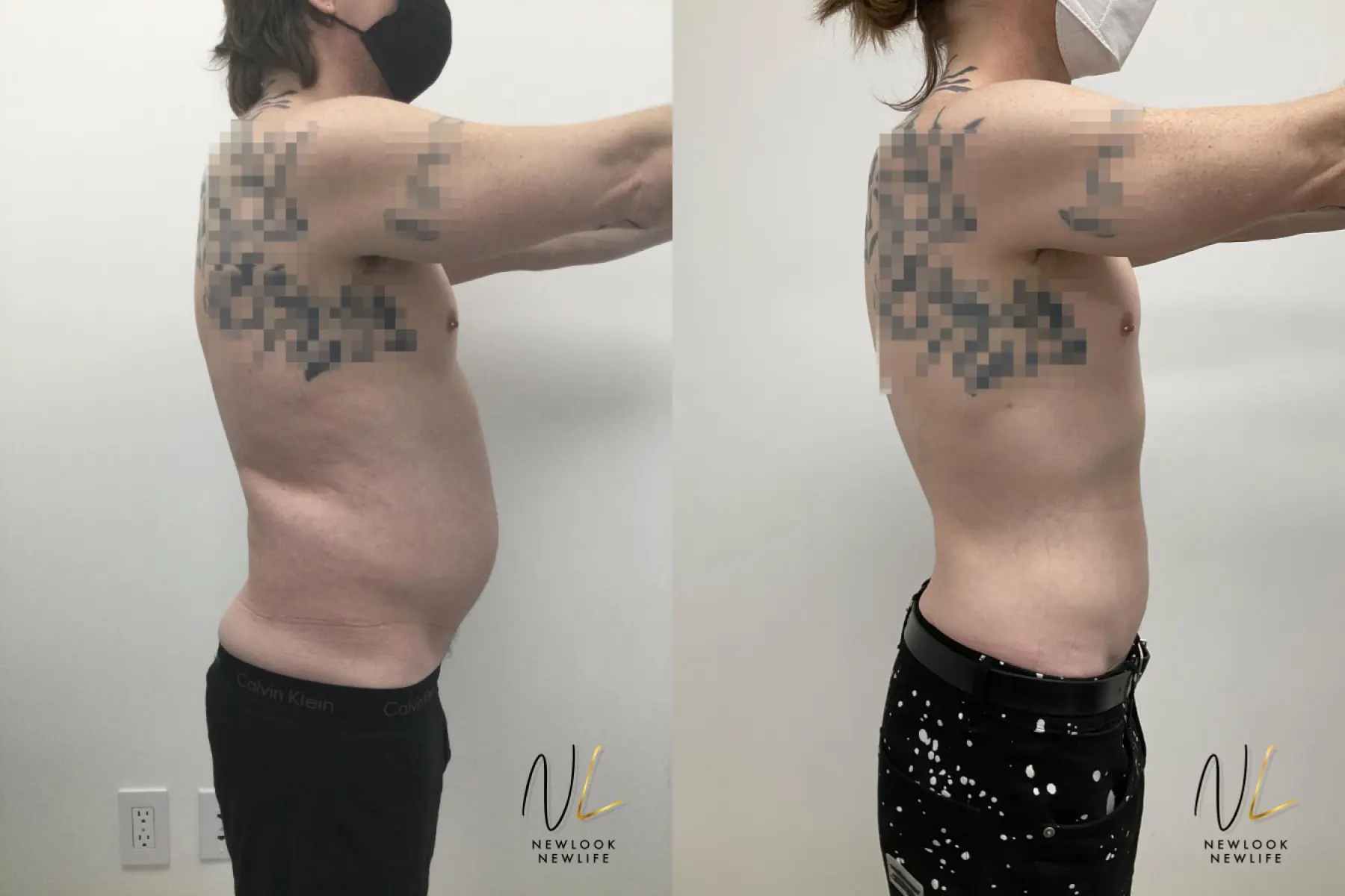 Male Liposuction: Patient 10 - Before and After 4