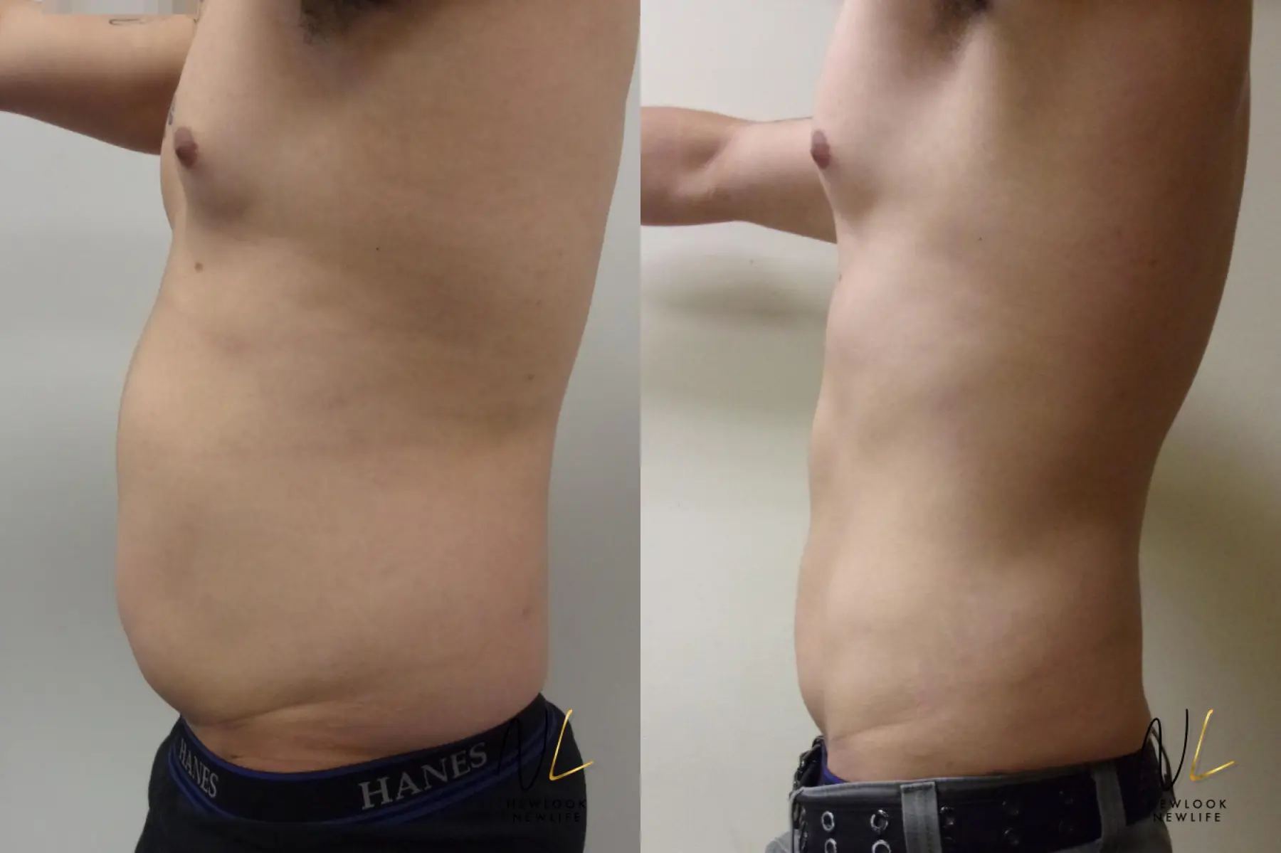 Male Liposuction: Patient 2 - Before and After 2