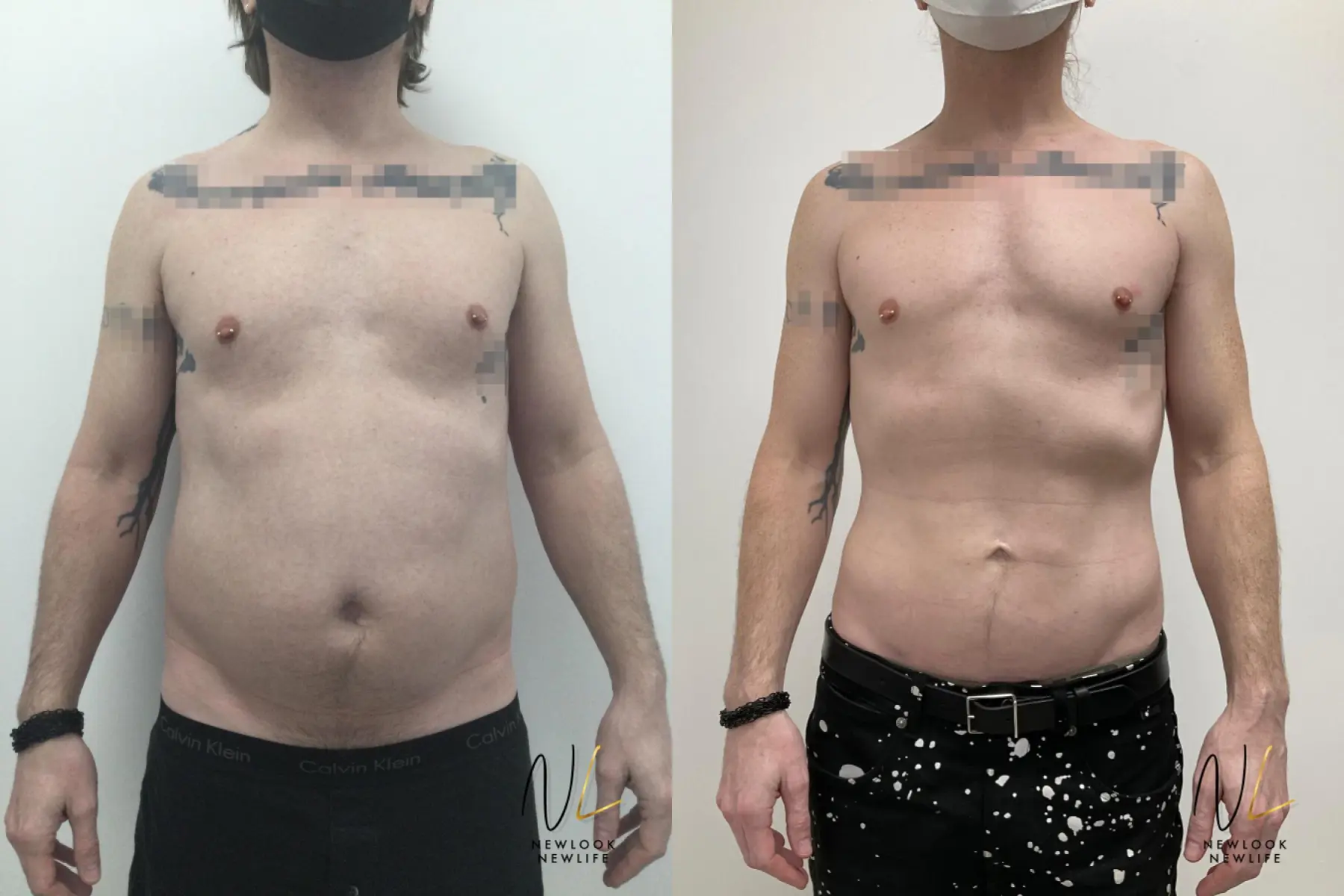 Male Liposuction: Patient 10 - Before and After 1