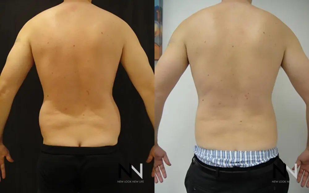 Male Liposuction: Patient 7 - Before and After  