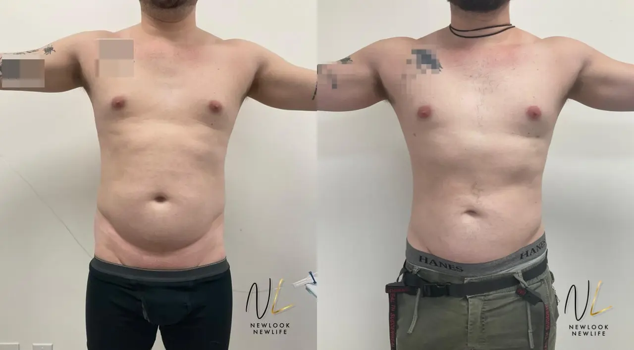 Male Liposuction: Patient 3 - Before and After  