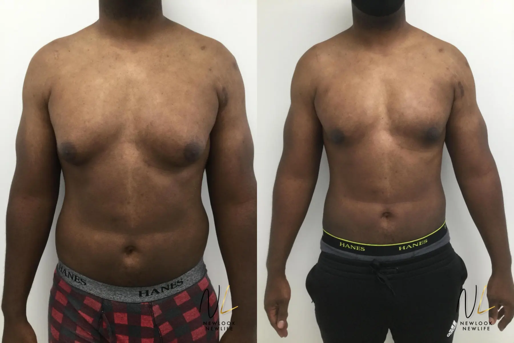 Male Liposuction: Patient 4 - Before and After 1