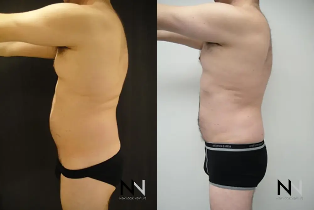 Male Liposuction: Patient 6 - Before and After  