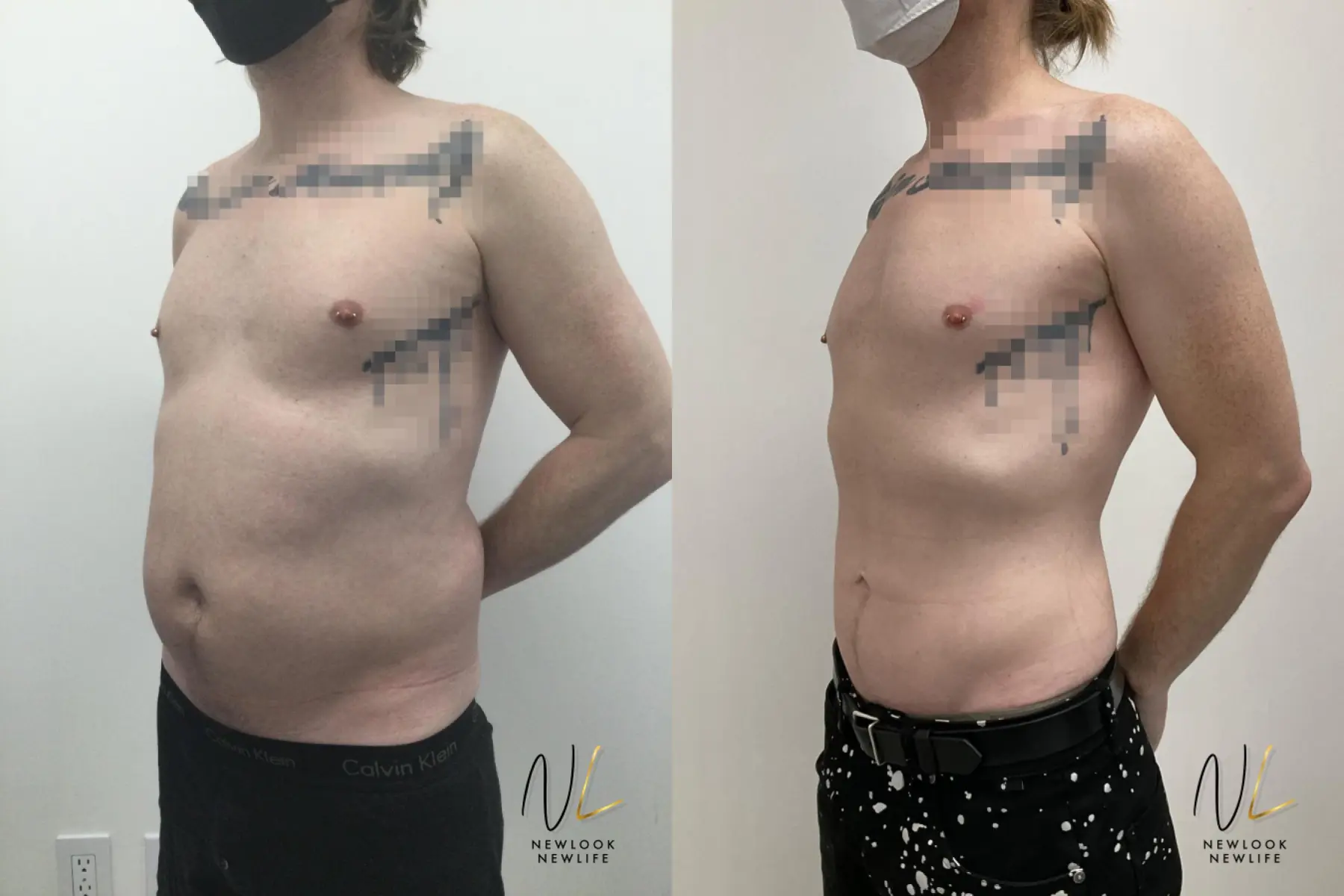 Male Liposuction: Patient 10 - Before and After 3