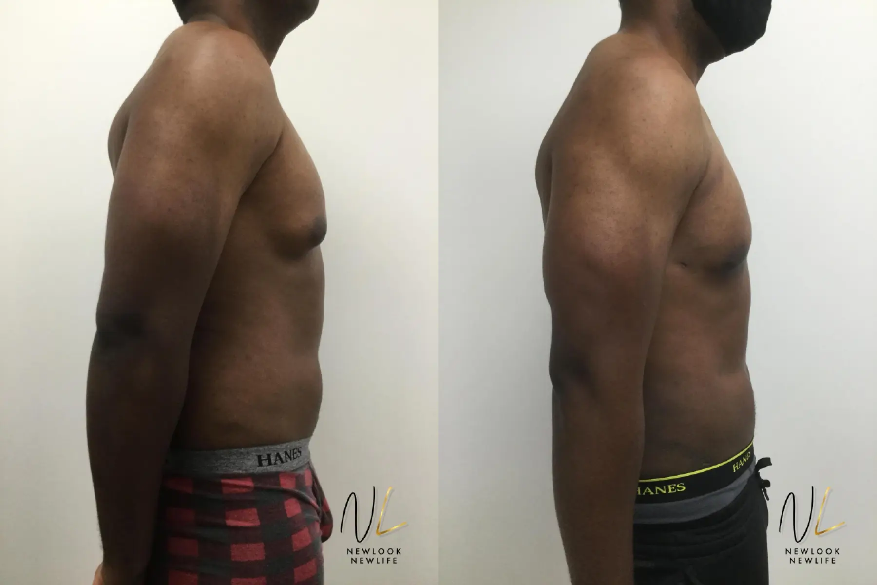 Male Liposuction: Patient 4 - Before and After 3