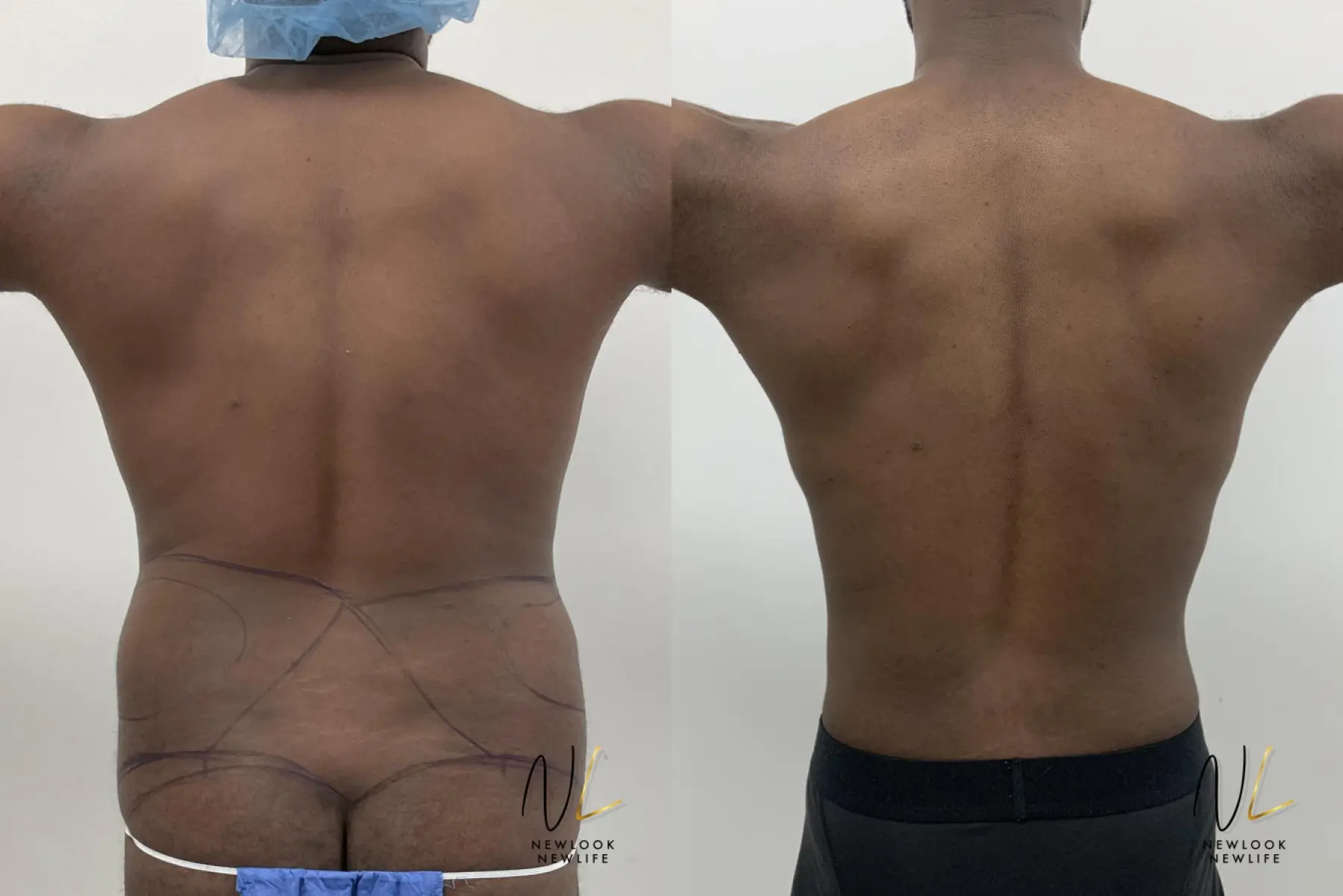 Male Liposuction: Patient 1 - Before and After 2