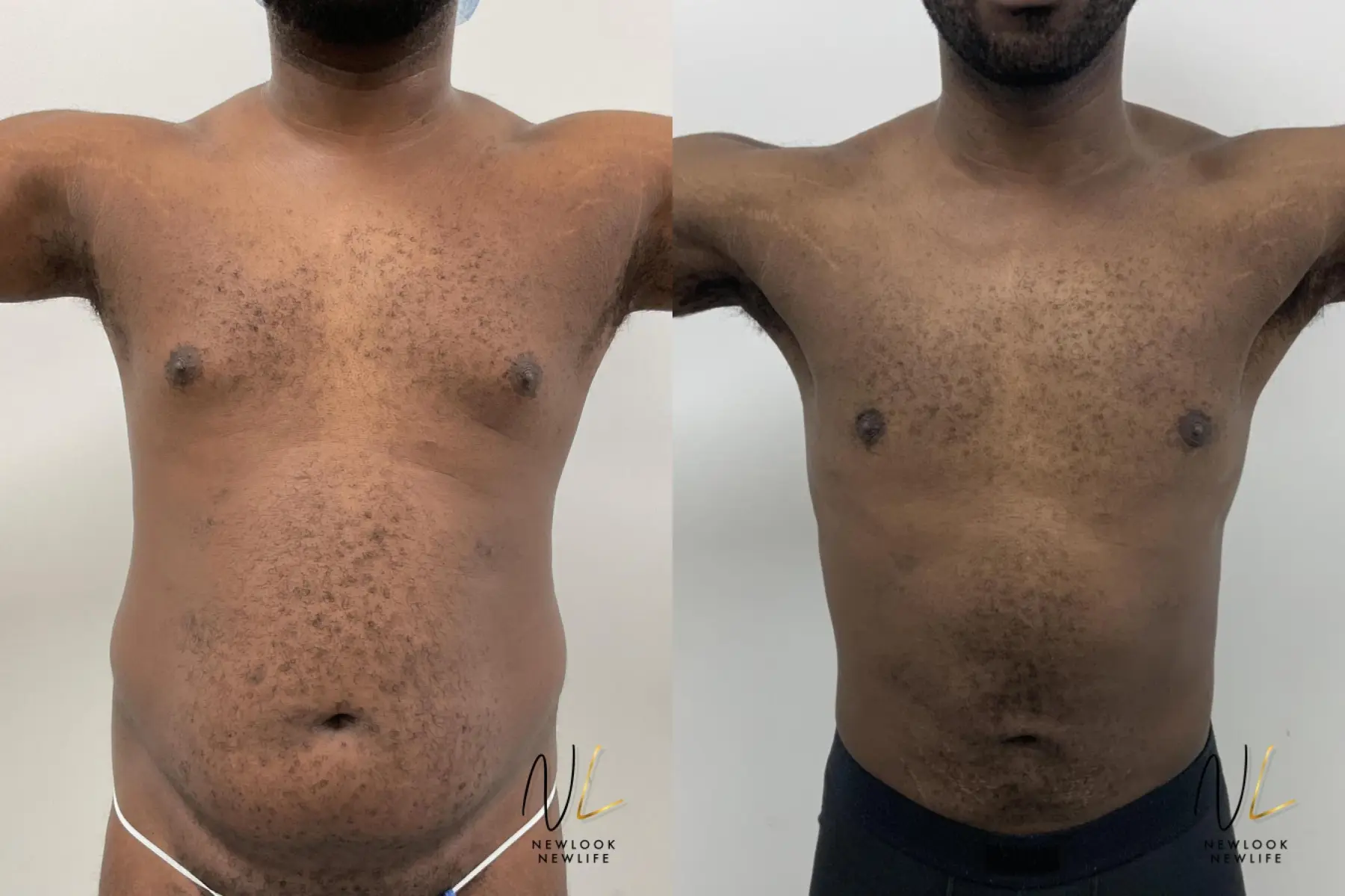 Male Liposuction: Patient 1 - Before and After 1