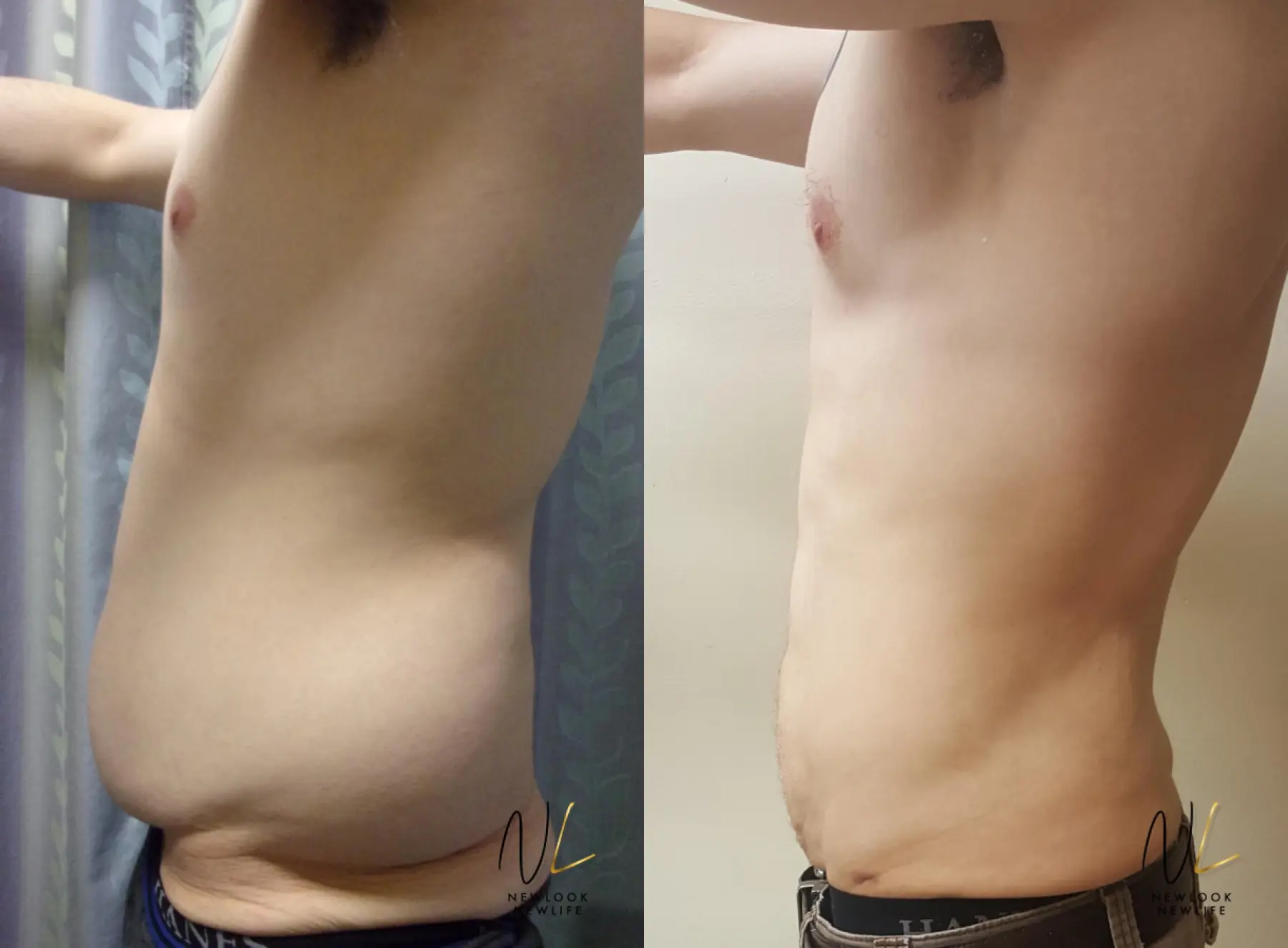 Male Liposuction: Patient 9 - Before and After 3