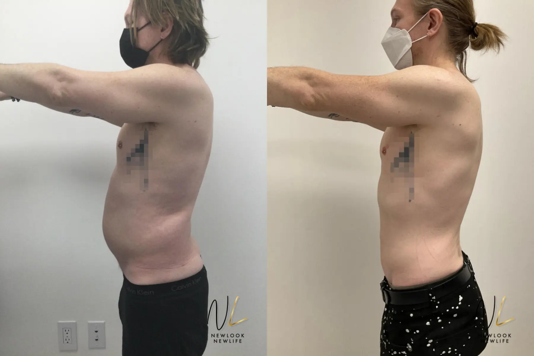 Male Liposuction: Patient 10 - Before and After 5