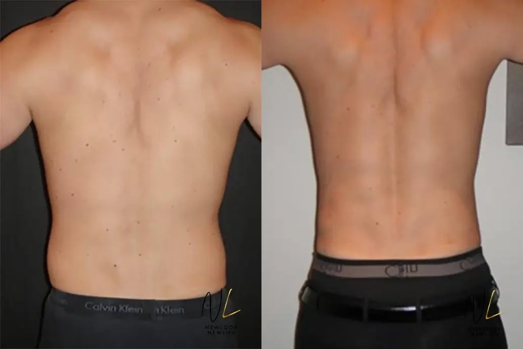 Male Liposuction: Patient 8 - Before and After  