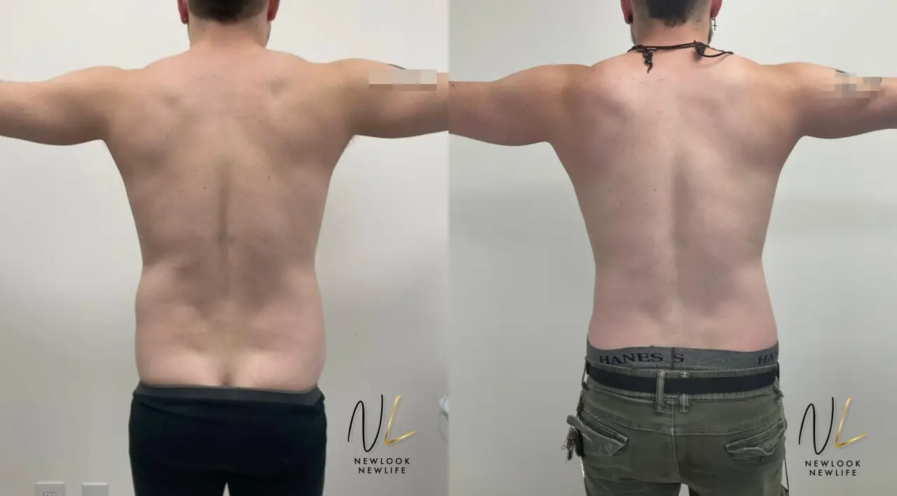 Male Liposuction: Patient 3 - Before and After 3