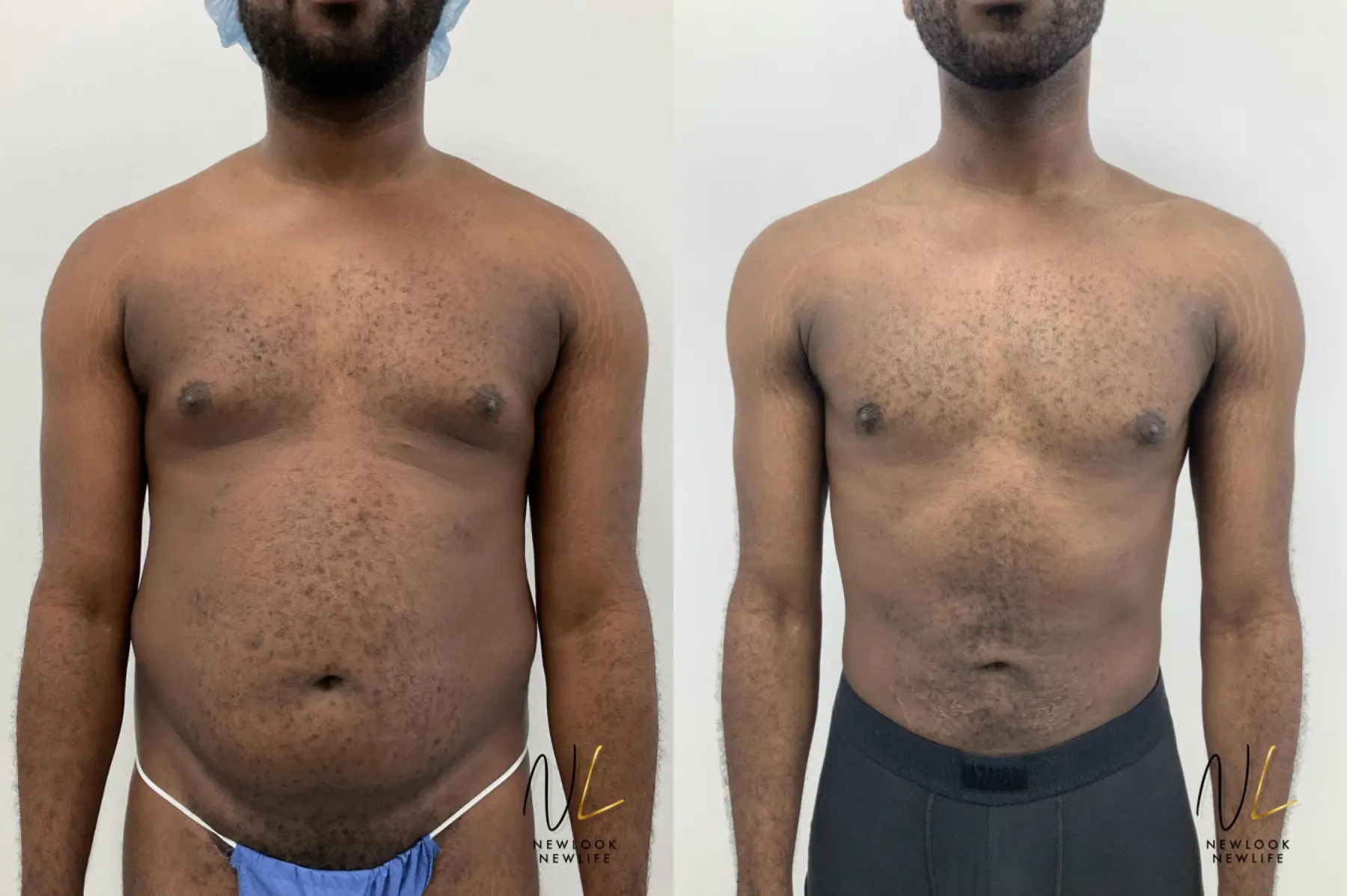 Male Liposuction: Patient 1 - Before and After 3