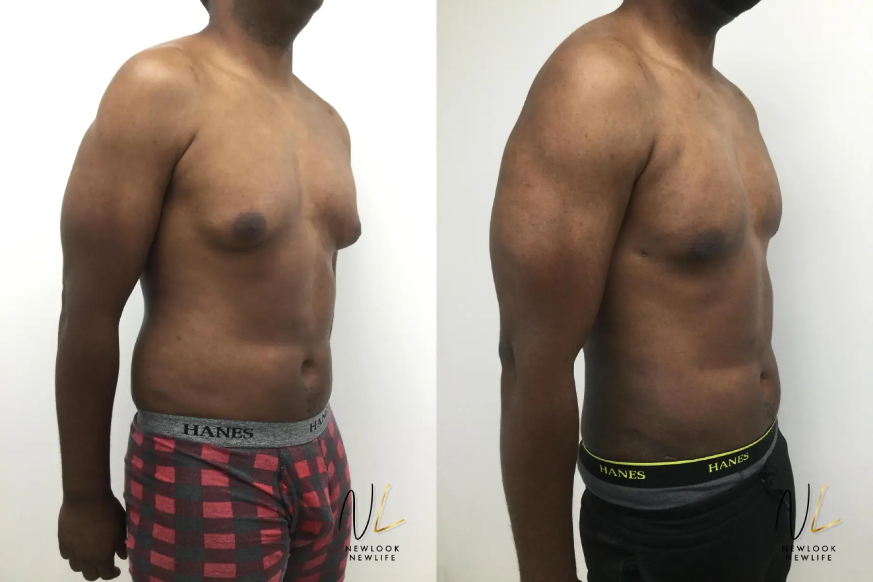 Male Liposuction: Patient 4 - Before and After 2