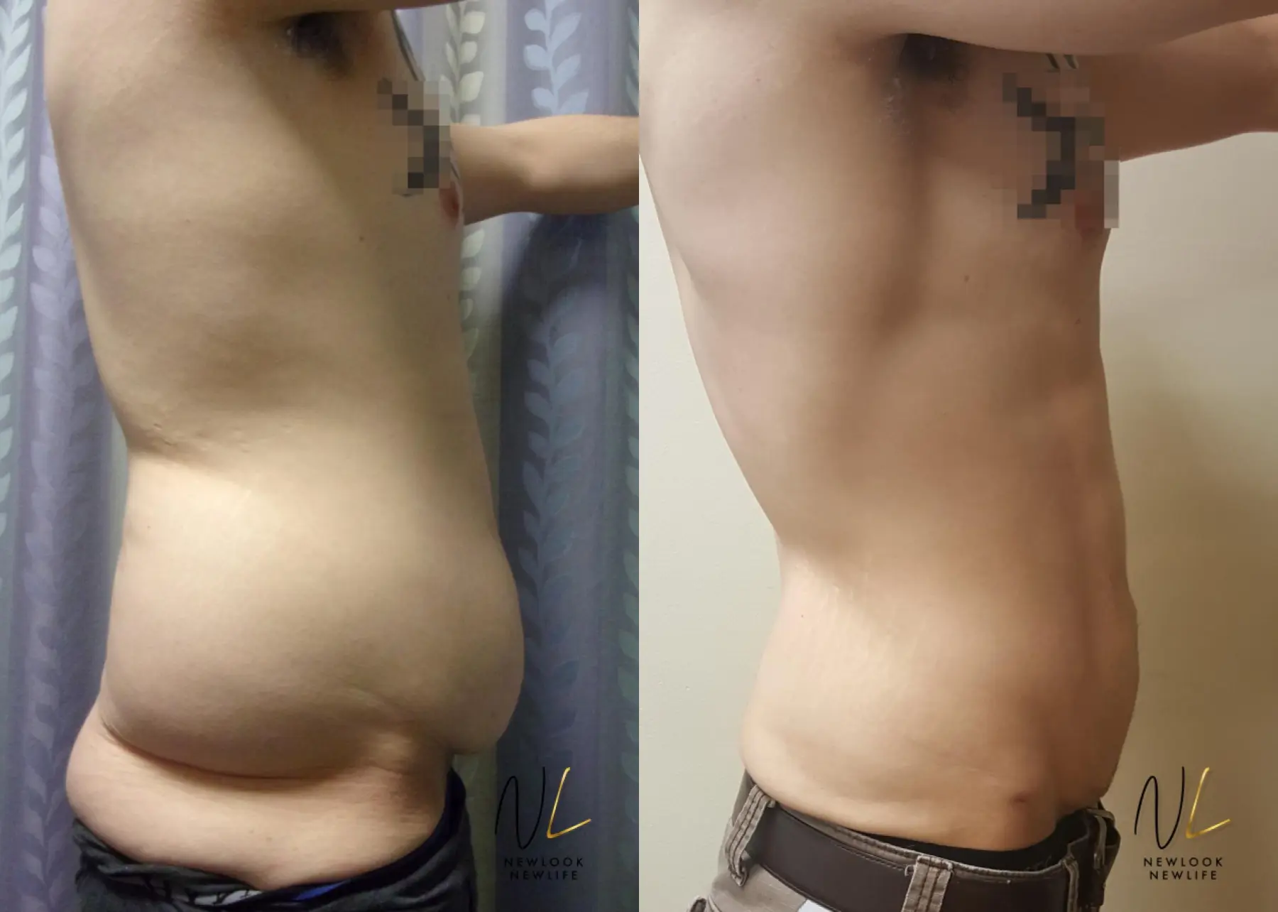 Male Liposuction: Patient 9 - Before and After 2