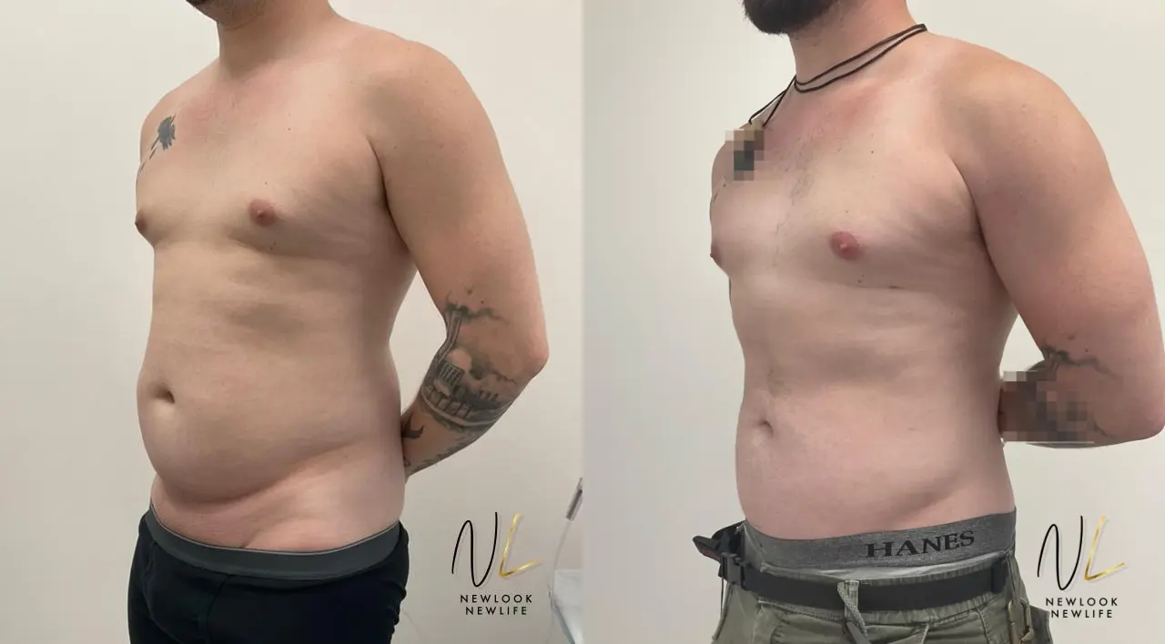 Male Liposuction: Patient 3 - Before and After 2